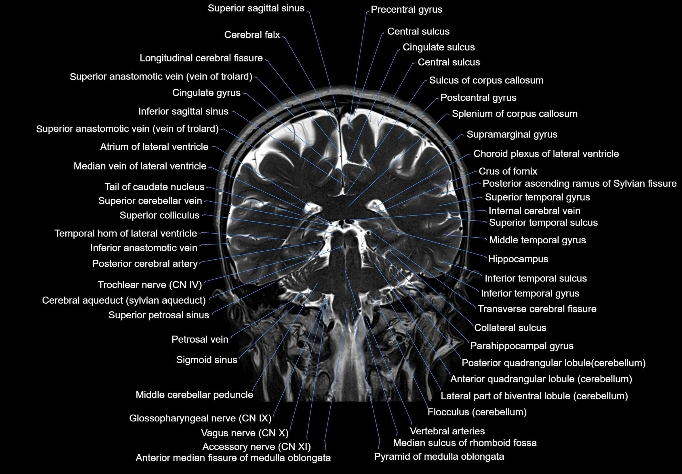 MRI Brain coronal cross sectional labelled anatomy 3T image  -img-00001-00047.webp